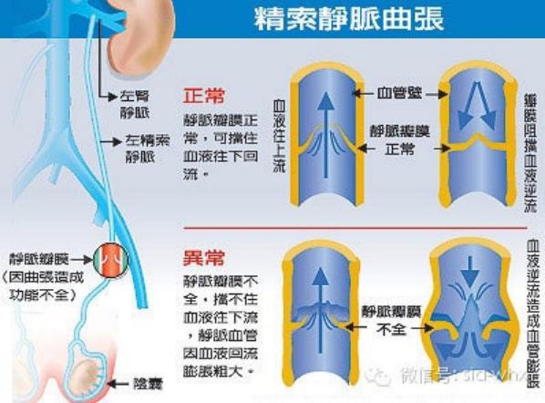 關(guān)于2021年征兵精索靜脈曲張標準的探討，2021年征兵精索靜脈曲張標準深度解析
